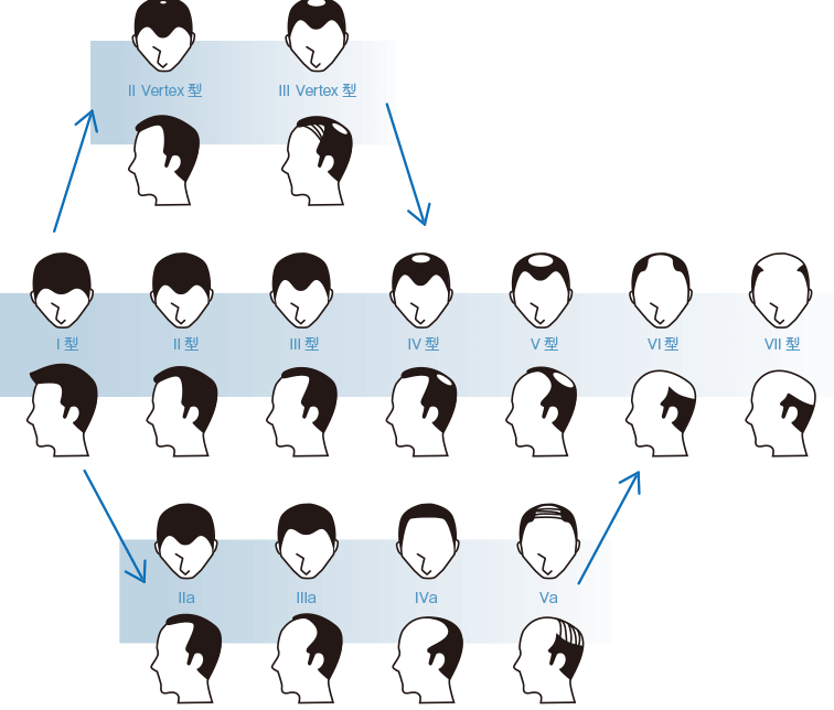 「M型の薄毛　Ⅱ Vertex型,Ⅲ Vertex型」「O型の薄毛　Ⅰ型,Ⅱ型,Ⅲ型,Ⅳ型,Ⅴ型,Ⅵ型,Ⅶ型」「全体的に後退　Ⅱa,Ⅲa,Ⅳa,Ⅴa」