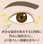 目の下の切らないクマ取り・たるみ(ふくらみ)取り+脂肪注入 傷跡 イメージ