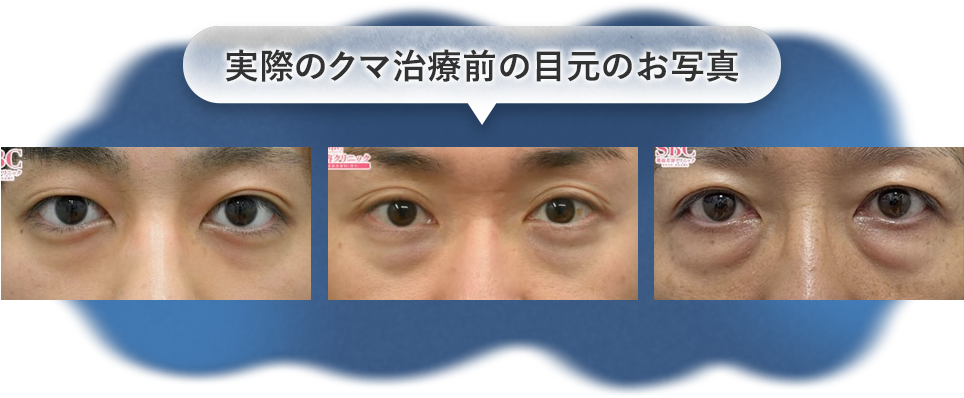 実際のクマ治療前の目元のお写真