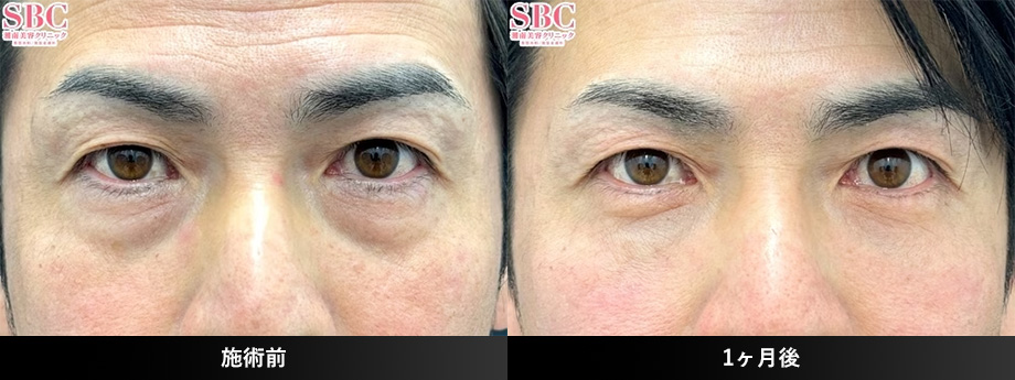 切開ハムラ(表ハムラ)40代症例写真