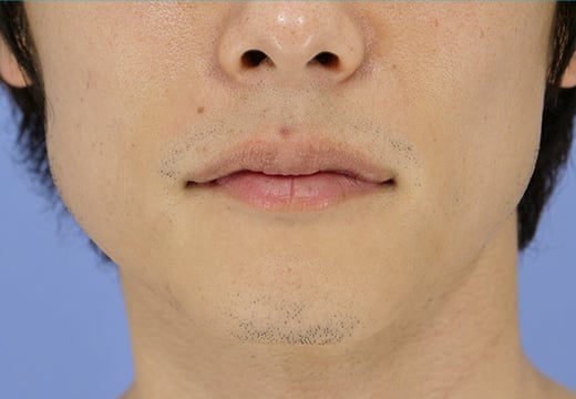 男性脱毛 ヒゲ 症例写真 6回目照射から2か月後