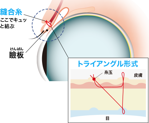 トライアングル形式