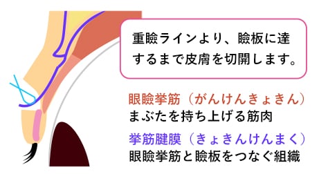 眼瞼下垂の施術方法 {切開}