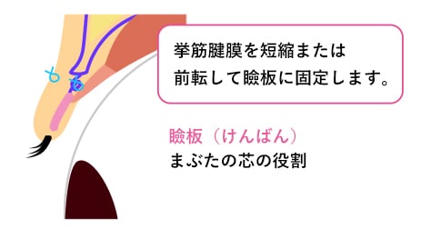 眼瞼下垂の施術方法 {固定}