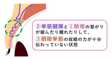 眼瞼下垂とは {眼瞼下垂}