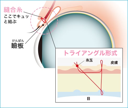 湘南美容クリニックのTeen二重®