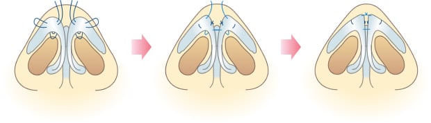 鼻尖形成術とは