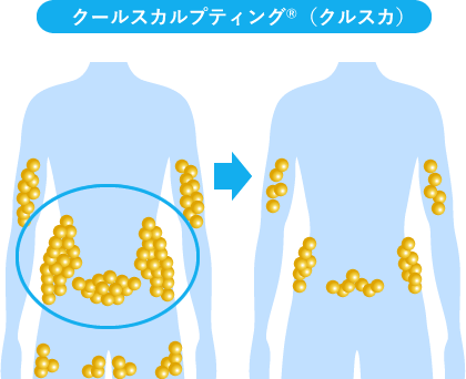 クールスカルプティング®（クルスカ）